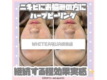 ホワイトアクア 岐阜店(WHITE AQUA)/ハーブピーリング/岐阜/毛穴