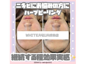 ホワイトアクア 岐阜店(WHITE AQUA)/ハーブピーリング/岐阜/毛穴
