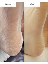 ケアプラス(care plus)/足裏角質ケア