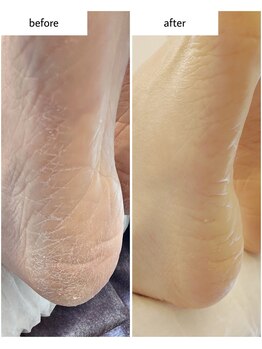 ケアプラス(care plus)/足裏角質ケア