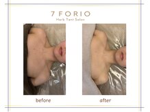 セブンフォリオ(7FORIO)/ダウンタイムなしの花嫁美容に