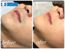 ボニート 堺東店(BONITO)/メンズ髭脱毛