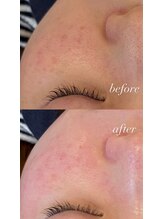 エレニア(Elenear)/お顔脱毛の効果