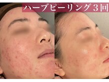 肌質改善も大人気◎ハーブピーリング・顔脱毛・小顔コルギ