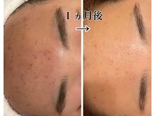 メナードフェイシャルサロン 片町店/ニキビ肌荒れ根本ケア