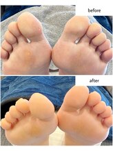 ケアプラス(care plus)/足裏角質ケア