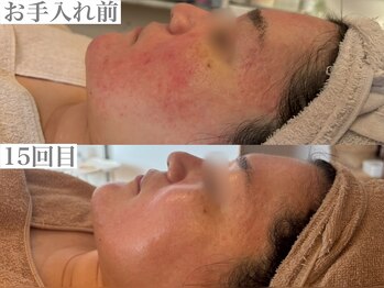 シーン(Sheen)/赤み改善し、むくみのスッキリ