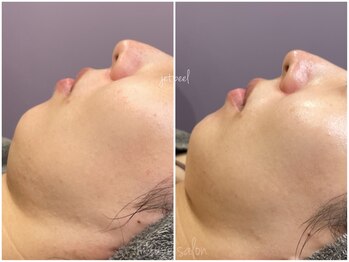 モーヴサロンエトフルール(mauve salon.et.fleurs)/ジェットピール・施術