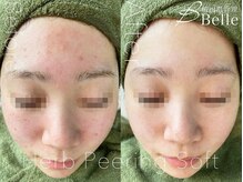 ベル 難波(Belle)/ハーブピーリング｜ニキビケア