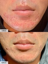 ドロップ 天王寺(DROP) ハーブ ピーリング