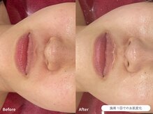 フォンビューティー(fon beauty)/透明感ケア1回