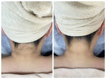 エクボ(EcBeau)/うなじ脱毛といえばエクボ!