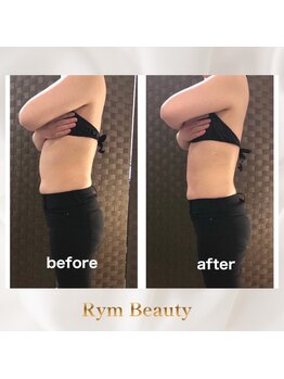 リム ビューティー(RYM BEAUTY)/最新超音波×インディバ