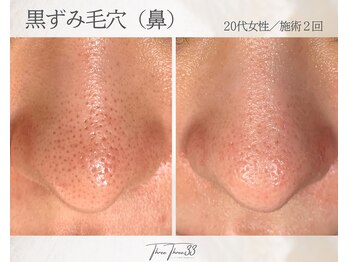 スリースリー 恵比寿(THREE THREE)/毛穴角栓・毛穴黒ずみ・毛穴開き