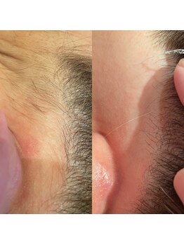 スタジオ プーナナ(Studio Punana)/うなじWax脱毛