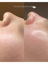 ゴールド 栄店(GOLD)/毛穴洗浄とスキンケアの相乗効果