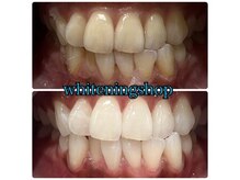 ホワイトニングショップ 天王寺店/10回ご来店後のお写真です