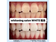 ホワイトニングサロン ホワイト(WHITE)/セルフホワイトニング/大阪/福島