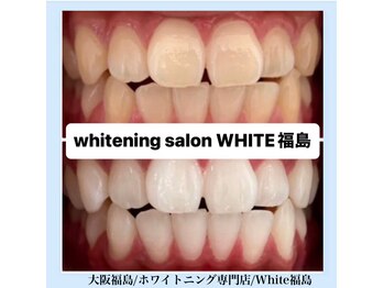ホワイトニングサロン ホワイト(WHITE)/セルフホワイトニング/大阪/福島