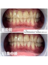 ホワイトニングサロン 京都烏丸店/ホワイトニング施術例