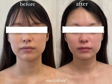 リノコロレ(ino.colore')/【人気No.1小顔コルギ】×1回