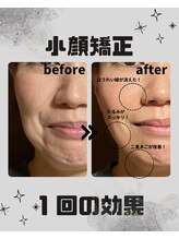 めいてる/小顔矯正/ほうれい線/大阪市