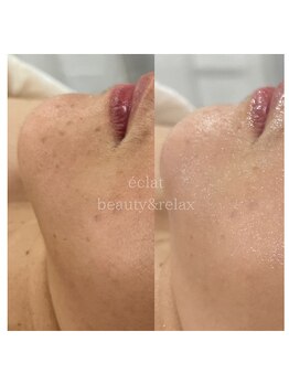 エクラ(eclat)/くすみ乾燥オフ