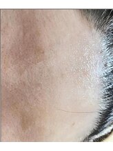 リベル 名古屋(Lebelle:)/ハーブピーリング　名古屋