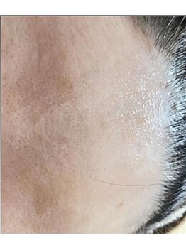 リベル 名古屋(Lebelle:)/ハーブピーリング 名古屋