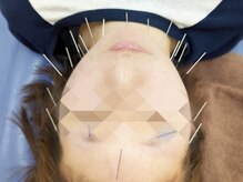 みてら鍼灸整骨院の雰囲気（美容鍼で、自然な美しさとリフレッシュを手に入れましょう！）