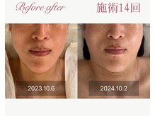 パルタージュ 三宮(Partage)/リフトアップ効果実感