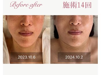 パルタージュ 三宮(Partage)/リフトアップ効果実感