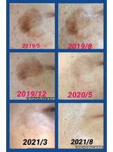 メナードフェイシャルサロン 藤沢駅北口店/シミケアの経過