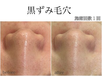 ラフェリ(Rafeli)/毛穴悩み