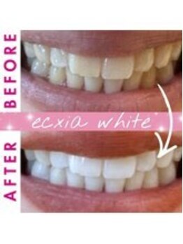 エクシアホワイトニング 長崎店/ホワイトニングビフォーアフター