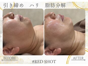 ナチュールファースト(naturel first)の写真/【人気急上昇！RED SHOT小顔フェイシャル！】
ダウンタイムが無く、脂肪分解と肌育のWアプローチ