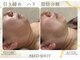 ナチュールファースト(naturel first)の写真/【人気急上昇！RED SHOT小顔フェイシャル！】
ダウンタイムが無く、脂肪分解と肌育のWアプローチ