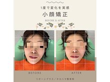 リボーンプラス タカハマ整骨院/【顎関節・小顔矯正】施術例