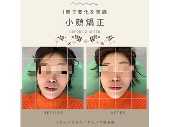 リボーンプラス タカハマ整骨院/【顎関節・小顔矯正】施術例