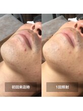 リムル(REMURU)/ひげ脱毛1回照射