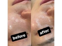 シャルム(CHARME)/ハーブピーリング