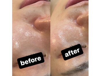 シャルム(CHARME)/ハーブピーリング