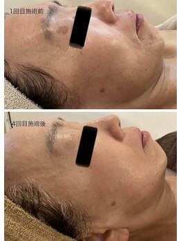 クロエクロウ(chloe'crow)/リバイブハーブ比較写真