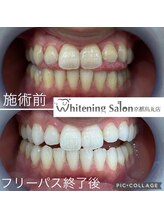 ホワイトニングサロン 京都烏丸店/ホワイトニング施術例