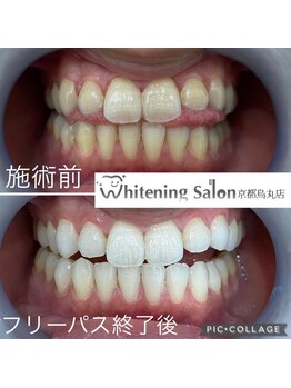 ホワイトニングサロン 京都烏丸店/ホワイトニング施術例