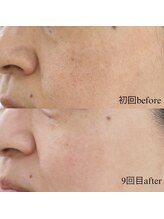 エクレクティック(ECLECTIC)/小顔/毛穴/フェイシャル