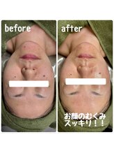 クラリ(Clari)/小顔/たるみ/浮腫み/くすみ