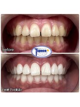 ティースペース(T-space)/クリスタルWhiteコース