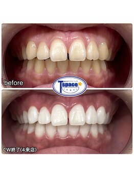 ティースペース(T-space)/クリスタルWhiteコース