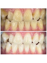 トムズ(Tom’s)/歯のセルフホワイトニング♪